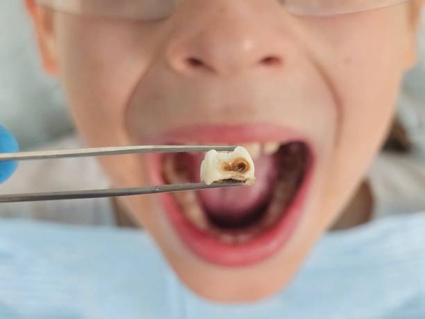 Best Emergency Dentist for Lost Fillings or Crowns in Lawrence, IN