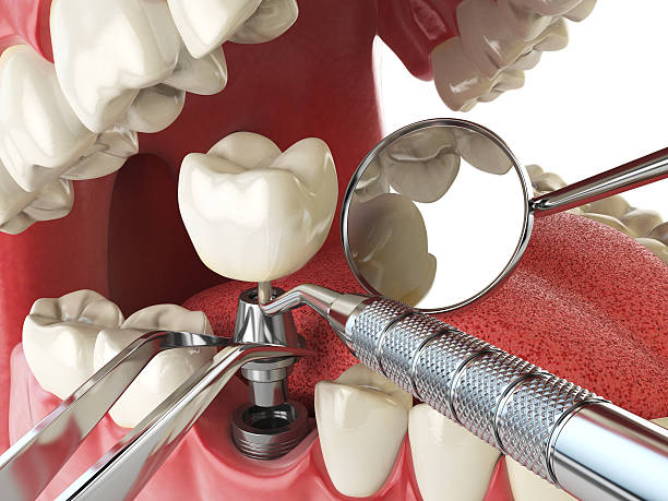 Best Emergency Dental Extractions in Lawrence, IN